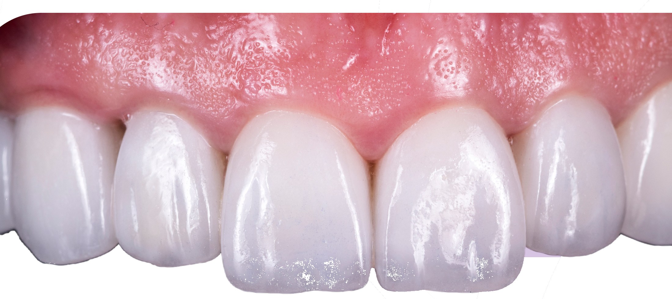 Después: diseño de sonrisa de 10 piezas en porcelana